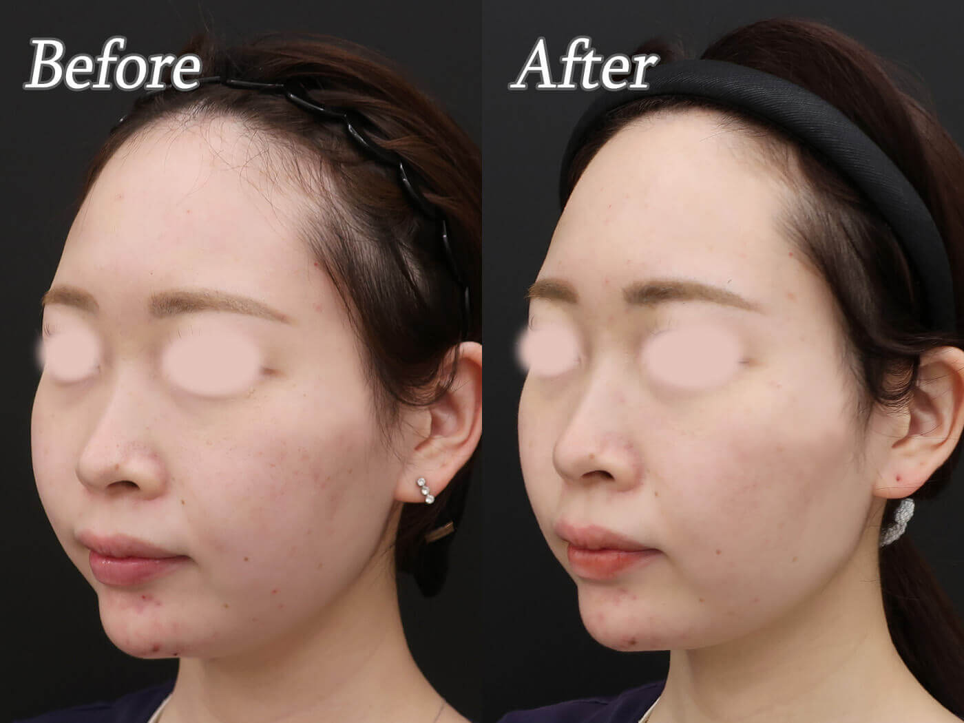 脂肪溶解注射の症例写真