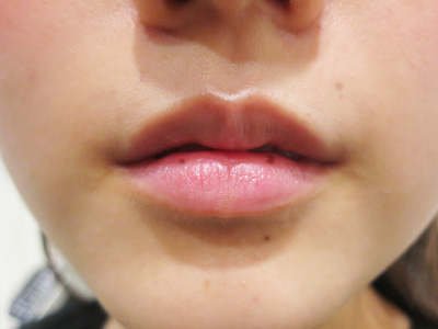 唇のほくろ 美容皮膚科女医のブログ